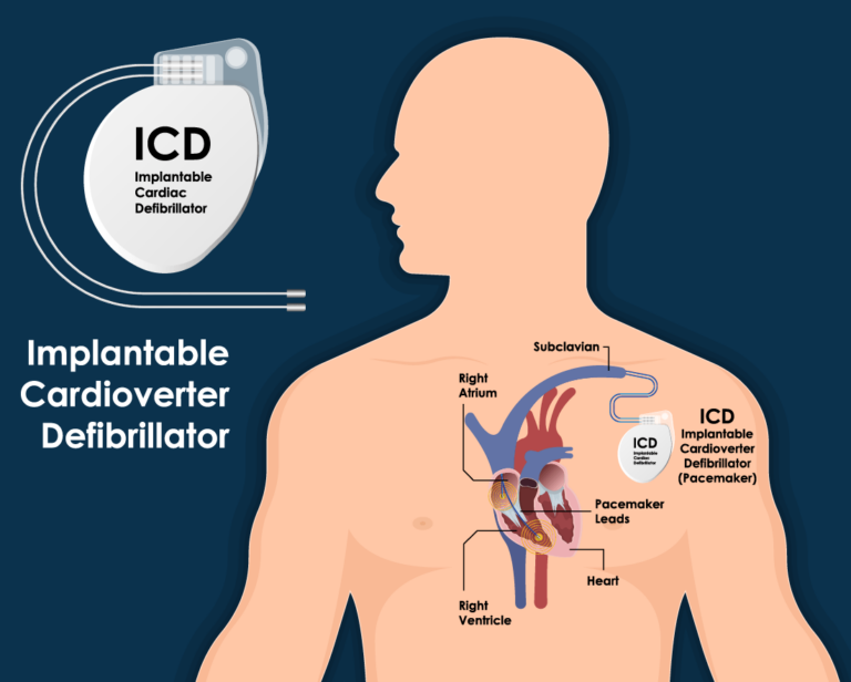 Illustration Implantable Cardioverter Defibrillator In The Body Showing Heart And Subclavian Artery
