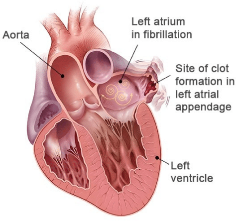 Illustration Of Cutaway View Of The Heart In Atrial Fibrillation