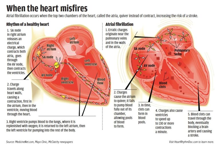 When Heart Misfires Infographic