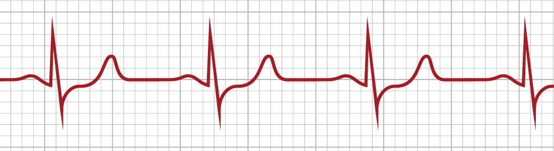 About Abnormal Heart Rhythms | Heart Rhythm Consultants